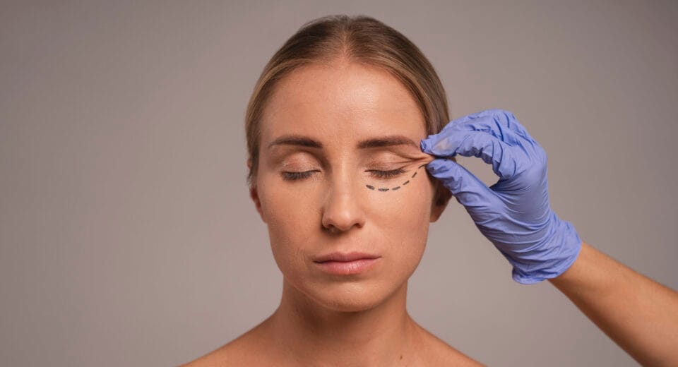 eyelid surgery blepharoplasty