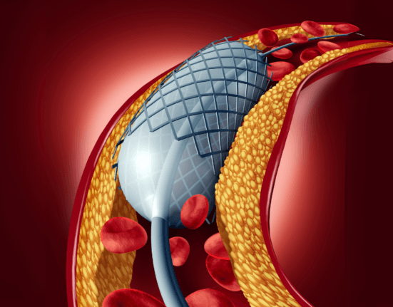 Coronary Angioplasty 1