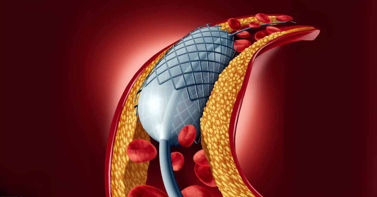 Coronary Angioplasty 1