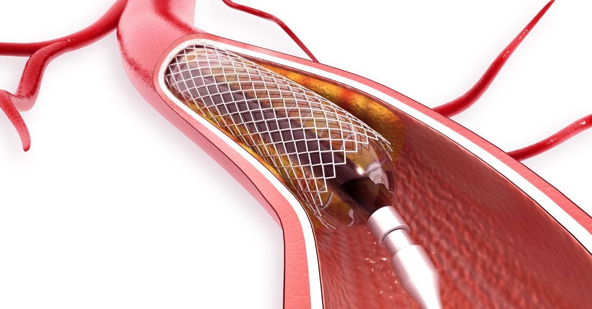 angioplasty cost