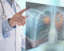 lung cancer singapore
