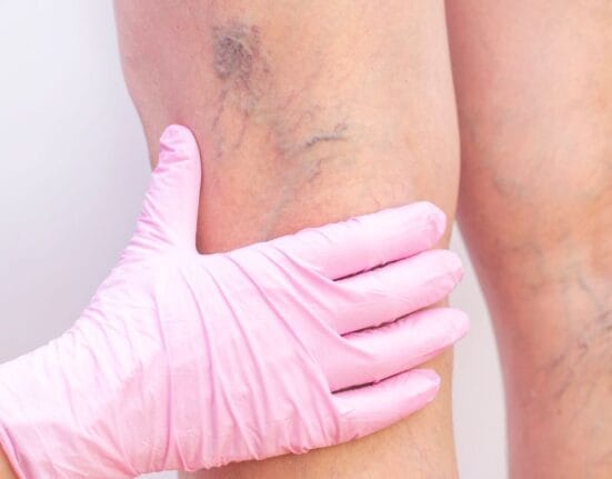surgical treatment for varicose veins