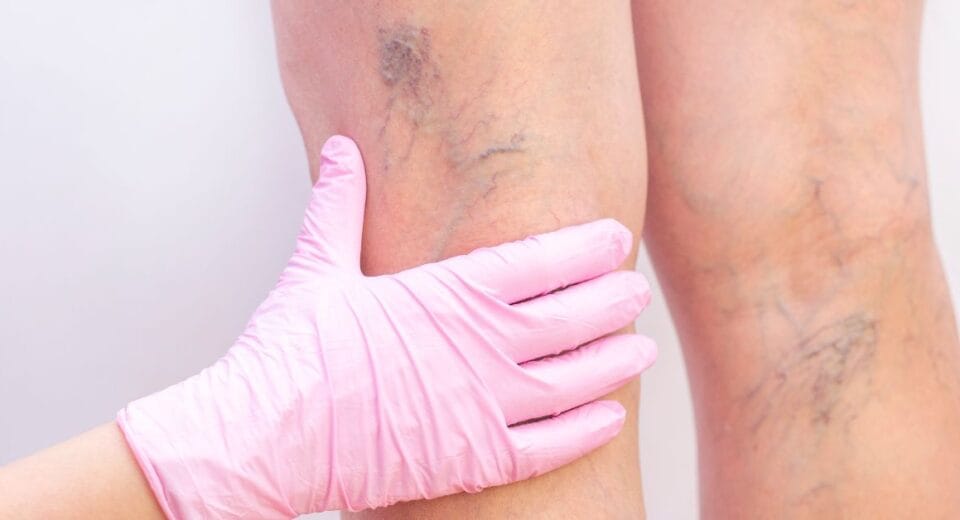 surgical treatment for varicose veins