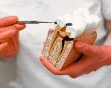 tooth decay treatment