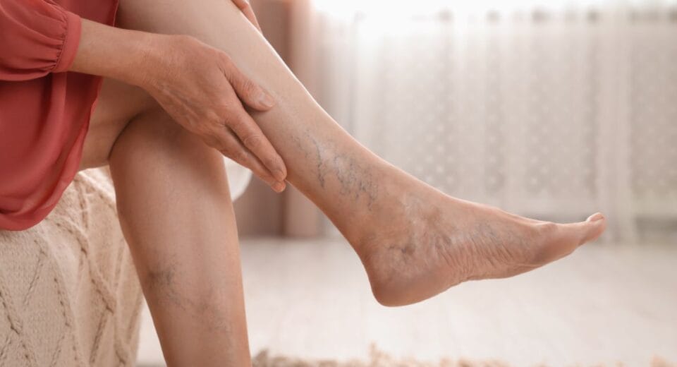 treatment for varicose veins in legs