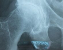 Hip-Osteoarthritis-Guide-keyart_TPHCM.jpg