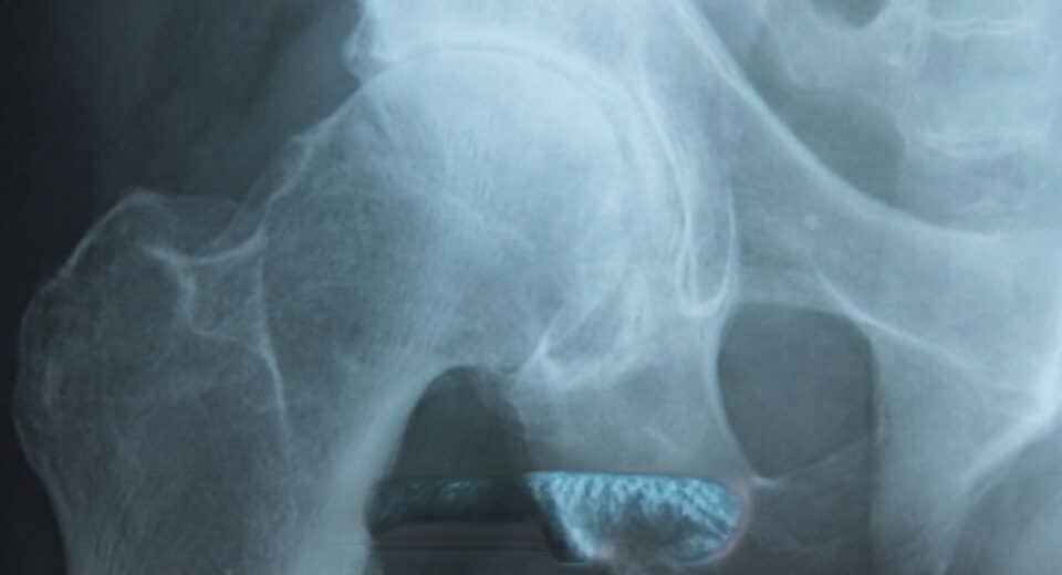 Hip-Osteoarthritis-Guide-keyart_TPHCM.jpg