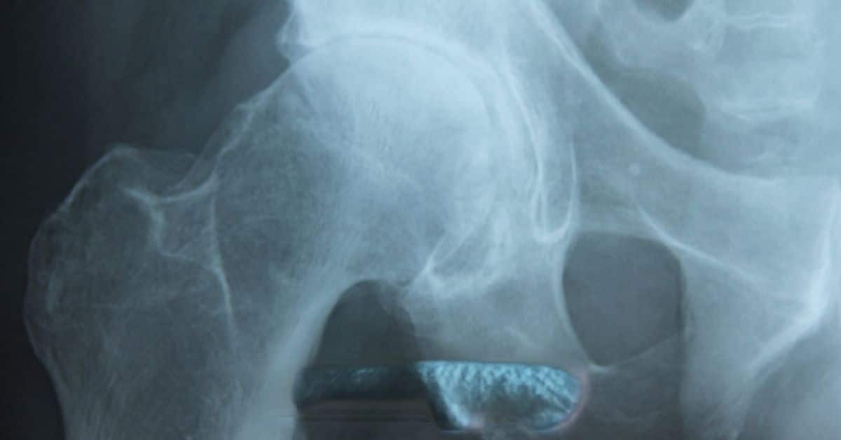 Hip-Osteoarthritis-Guide-keyart_TPHCM.jpg